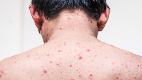 皮肤科 带状疱疹 症状 带状疱疹初期症状表现为典型的皮损,可以在炎症