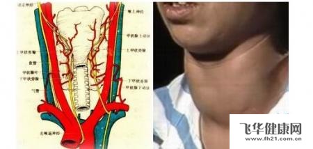 脖子肿大是淋巴结还是血管瘤