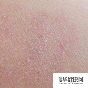 泛发性神经性皮炎用什么药物好呢