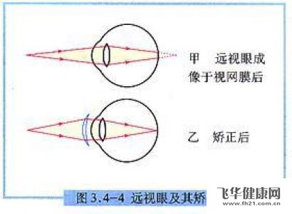 用什么方法可以知道自己远视眼的度数