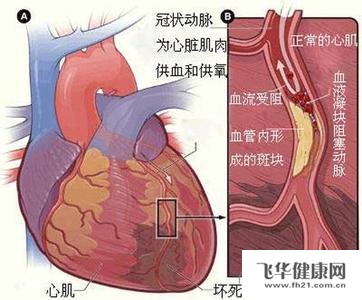 心脏肥大心肌梗塞还有冠心病怎么治疗