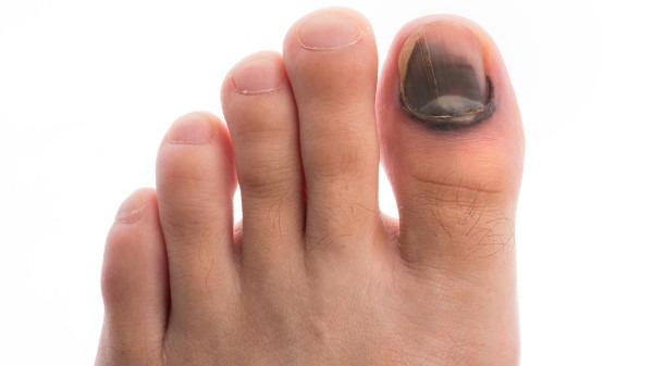 灰指甲会使指甲出现凹凸不平,粗糙,颜色发黄等多种的症状