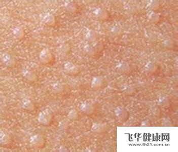 七年前身体腰部长扁平疣还能治愈吗