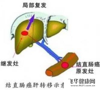 疾病百科 肝癌 经验分享 1 首先,继发性肝癌的