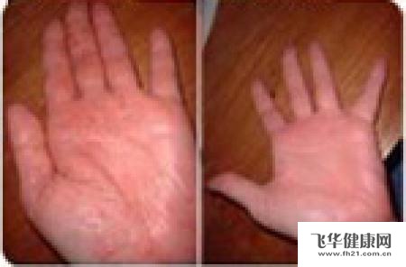 脂溢性皮炎的预防和保健