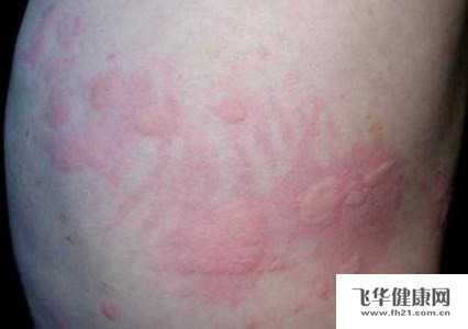 孕期起红疹怎么办?