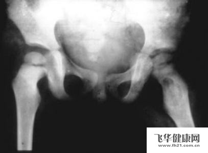 关于脊柱,膝关节,髋关节结核