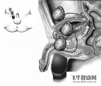 有多睾症怎么办