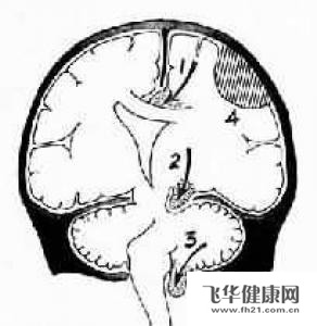脑疝的处理