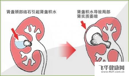 有关肾积水的治疗方法