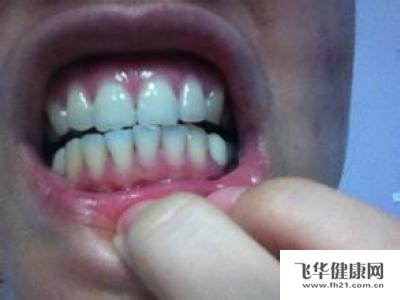 什么是牙龈萎缩