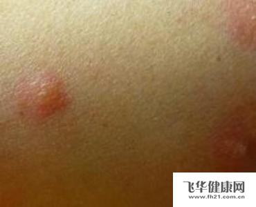黑色丘疹性皮肤病的预防偏方有哪些