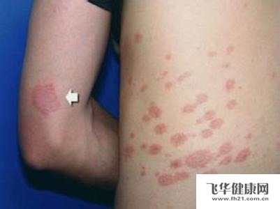 玫瑰糠疹是什么症状