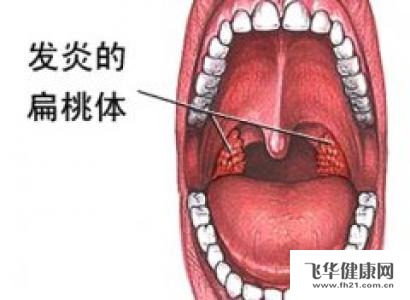 该如何治疗慢性扁桃体炎