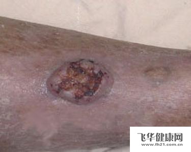 各类皮肤癌的早期表现多为红斑状的皮损,伴有鳞片状的脱屑或者痂皮的