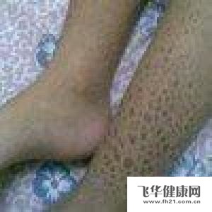 如何来治疗鳄皮婴儿综合征