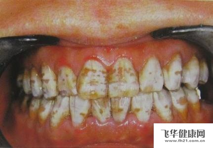 如何做才能防止孩子有四环素牙呢