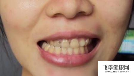 01 02 由上后牙颊向错位或颊斜引起的锁合,一般通过上下颌间的牙的