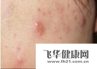 颜面部有疖痈怎么护理