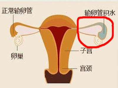 输卵管积水症状及治疗