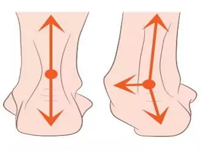 痛风与跟腱炎的区别