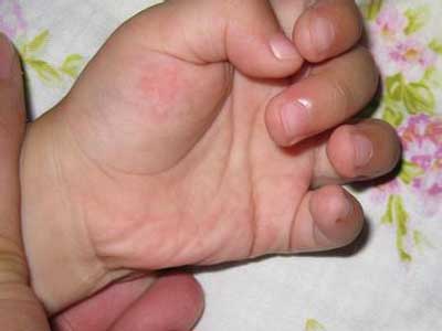 如何预防小儿手足口病 宝贝们的健康如何保证