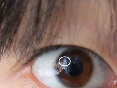 眼睑缺损合并睑裂闭合不全时,可发生暴露性慢性角膜炎等.