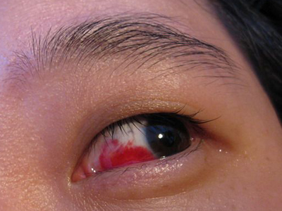 眼睛充血是什么原因