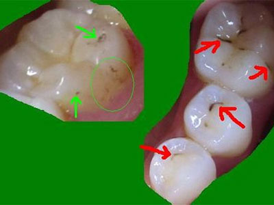 婴儿牙菌斑太可怕 预防很重要