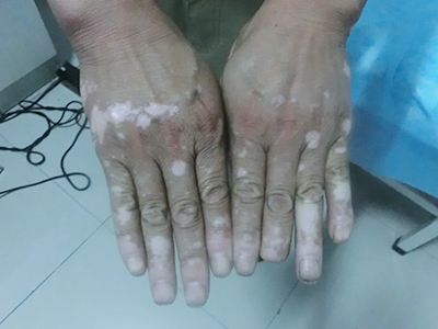 老年白癜风和老年白斑应该怎样区分