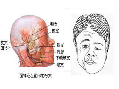 中医认为面肌痉挛与哪些原因有关系