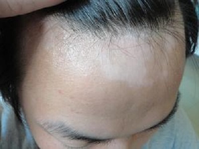 白癜风早期能治愈吗:头上有白斑怎么治疗效果好?