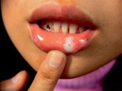 口腔白斑是什么怎么治疗