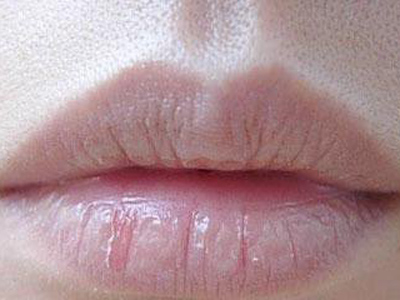 唇炎有哪些的症状?