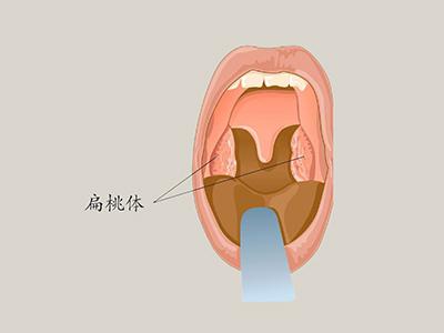 扁桃体肥大有什么危害