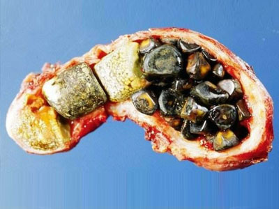 患者吃什么药能使胆囊结石变小
