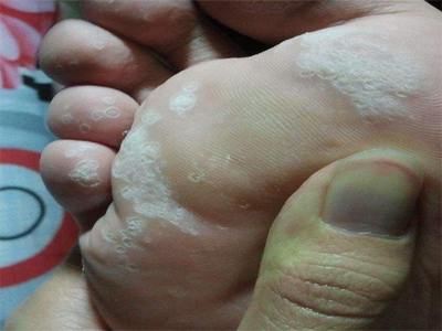 脚上瘙痒就是脚气?如何与湿疹区分