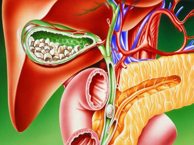 [转载]【民生泰健康讲堂】胆囊炎胆结石什么症状