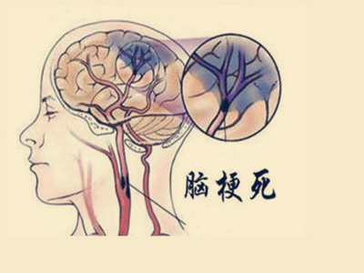 老年人多看看脸,发现脑梗前兆可以救命!