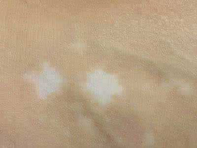 白癜风虽然是皮肤的白斑,但它并不是皮肤色素问题那么简单.