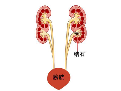 得了肾结石不痛需要治疗吗