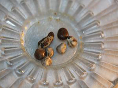胆囊结石0.9cm属于严重吗