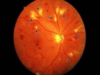 眼底出血症状图片,眼睛出图片大全,什么叫眼底出图片_大山谷图库