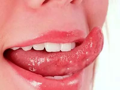 如何治疗萎缩性舌炎