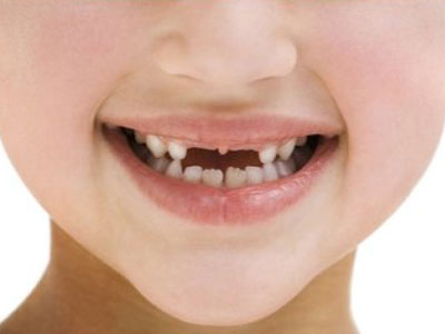 孩子换牙期间家长应注意什么