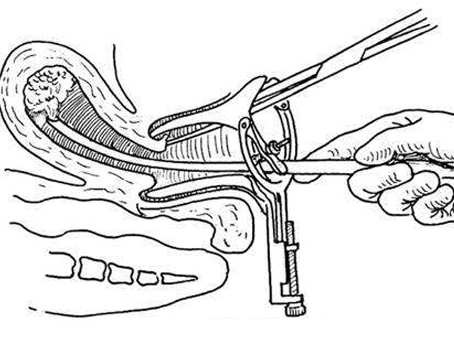 刮宫疼吗?详解流产后刮宫有多疼的具体事项