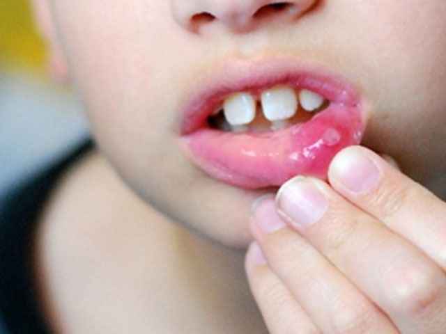 口腔溃疡都有哪些症状?这3个症状是最常见的