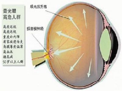 中医有哪些方法治疗青光眼?