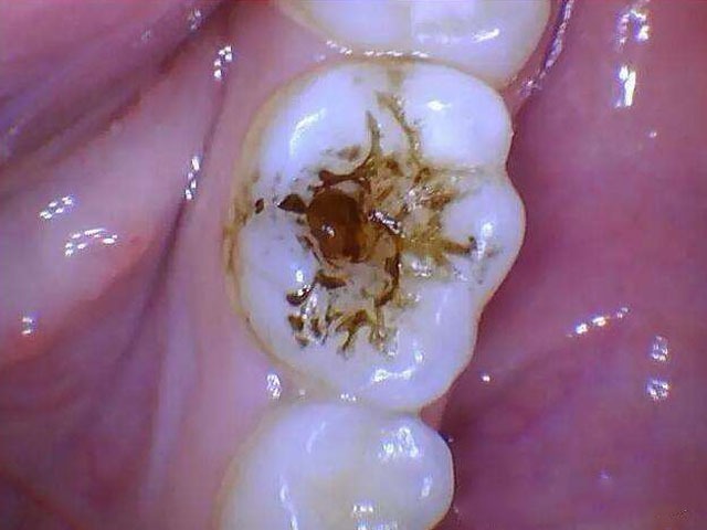 闫春歌介绍,"牙洞"也就是我们常说的蛀牙,龋齿,一般按照病变深度分