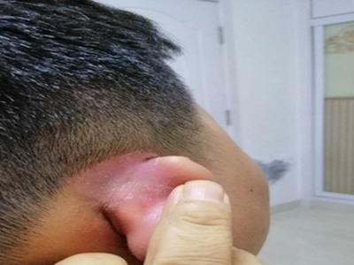 除皮肤病变以外,甲病变亦是银屑病的常见表现,银屑病可能是常伴有甲